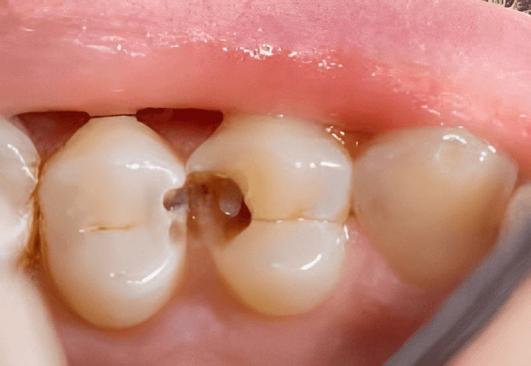 Dental Fillings and Restorations - AllCare Beenleigh Dental