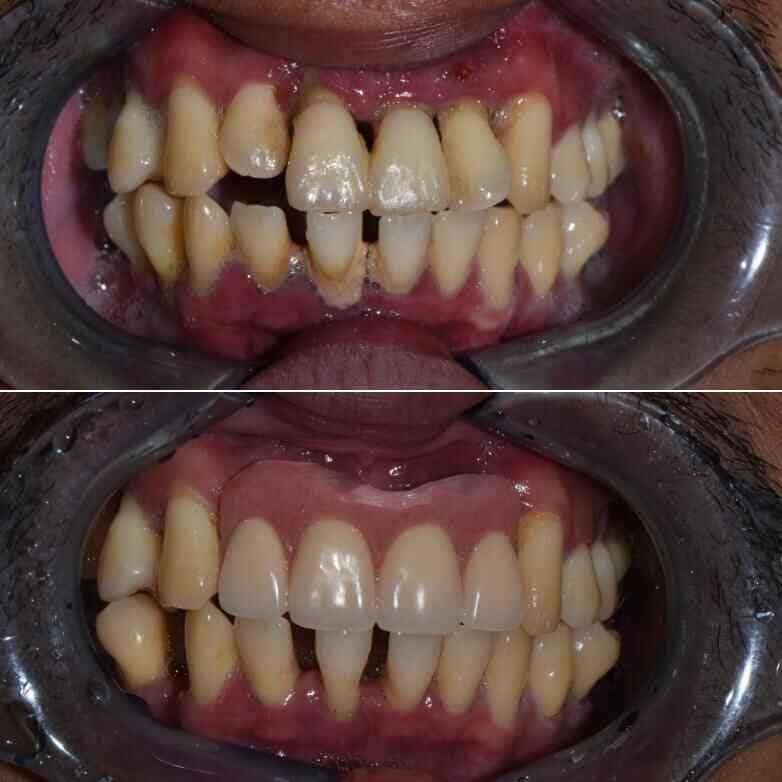 Patient Results AllCare Beenleigh Dental