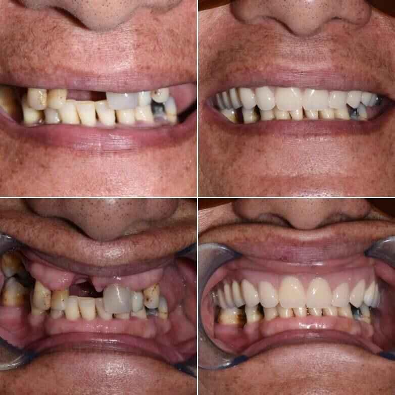 Patient Results AllCare Beenleigh Dental