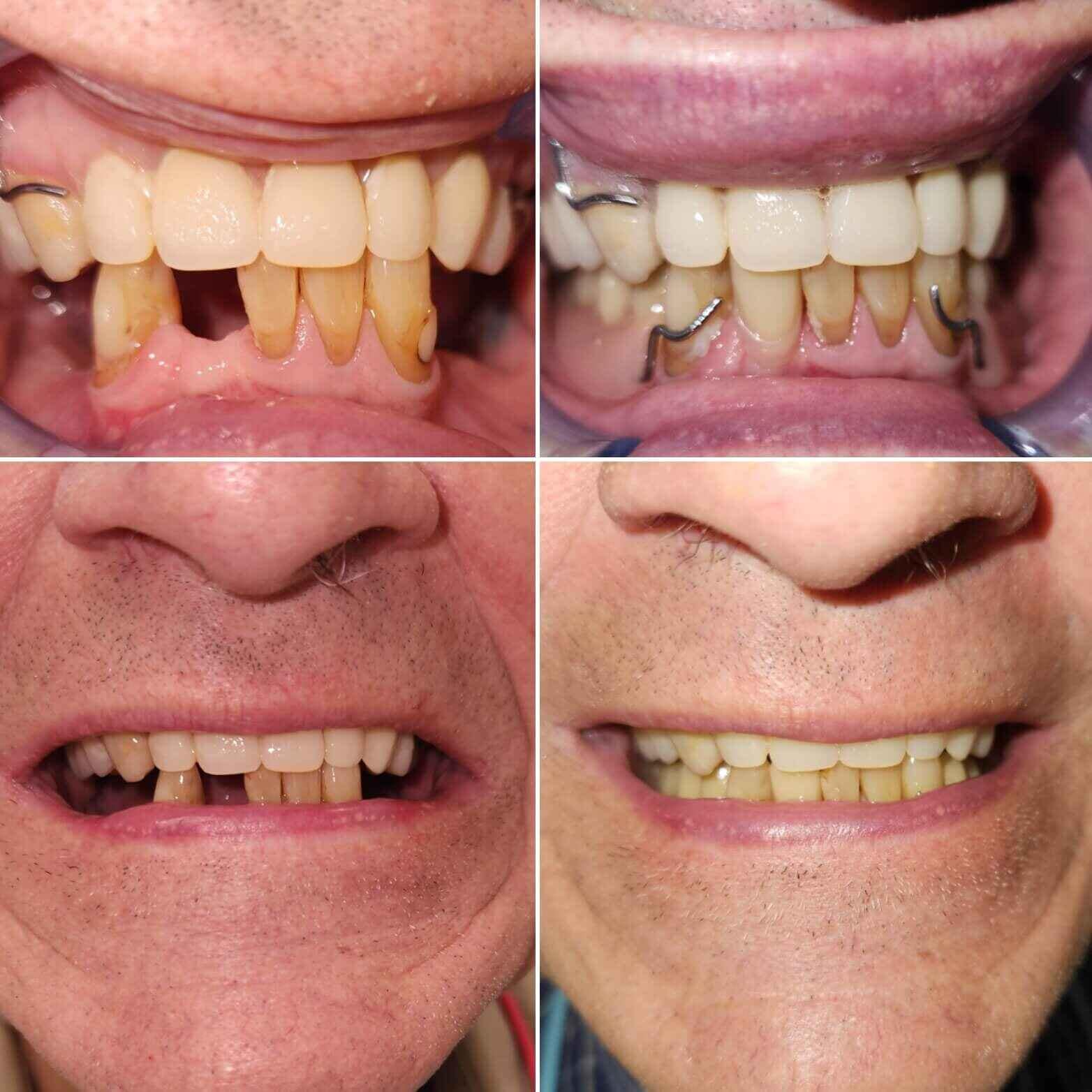 Patient Results AllCare Beenleigh Dental